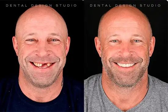 dental implants cancun mexico cancun dental implants